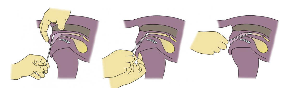 Picture 1 : การเก็บตัวอย่างเซลล์ทำ Vaginal Cytology (www.vetmed.lsu.edu)